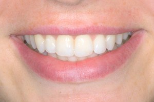 Straighten Teeth