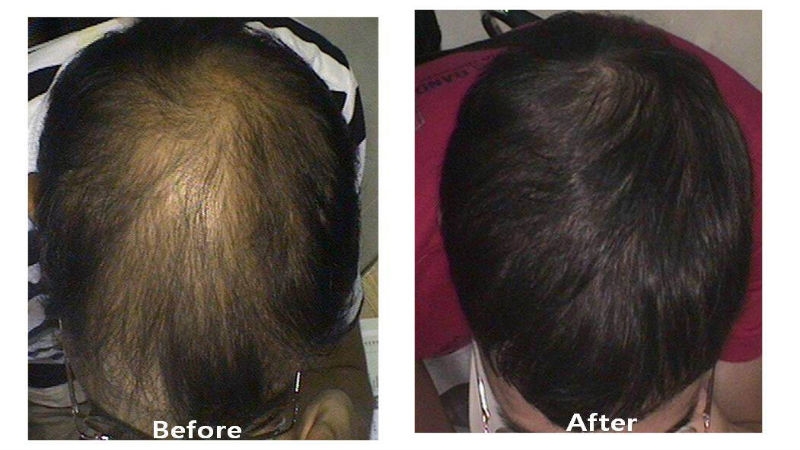 Suffering From A Hair Loss Problem? Try Platelet Rich Plasma Therapy